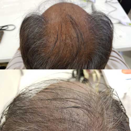 Hair Scalp Treatment In Nashik